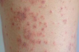 بررسی و شناخت علل لکه های قرمز روی پا + روش های درمان